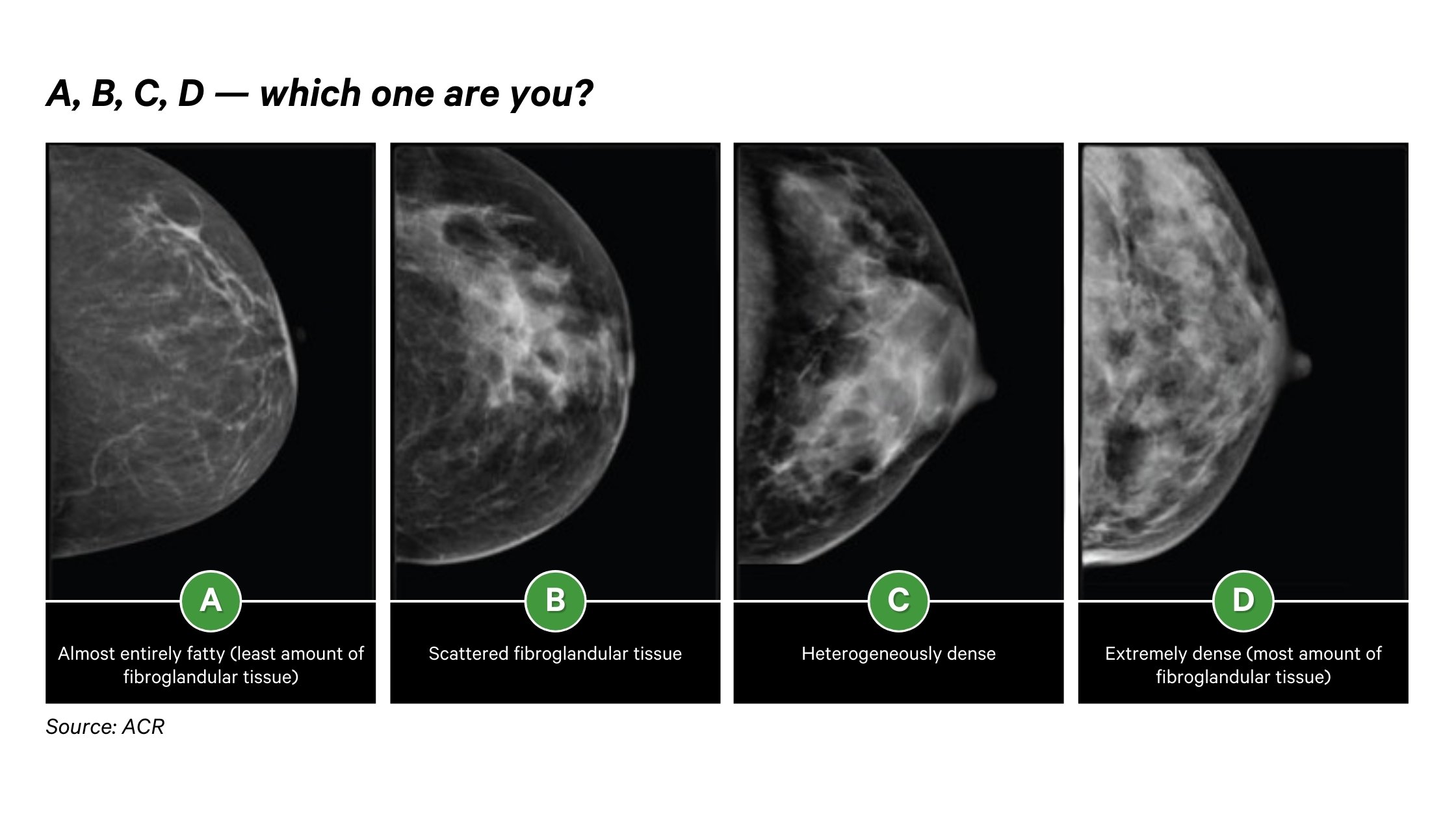 Know Your Breast Density Know Your Cancer Risk How AI Helps Patients